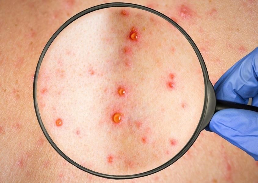 Đậu mùa khỉ có thể lây giữa người với người, động vật nhiễm bệnh với người. Nguồn từ North Edinburgh News