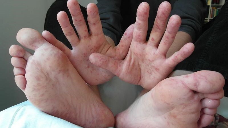 Phát ban ở lòng bàn tay và bàn chân là dấu hiệu thường thấy khi bị bệnh tay chân miệng