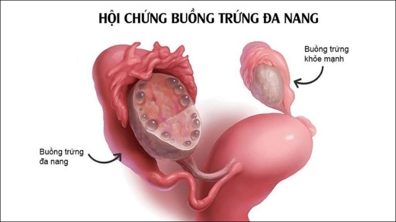 Hội chứng buồng trứng đa nang (PCOS) có thể khiến việc giảm cân khó khăn hơn