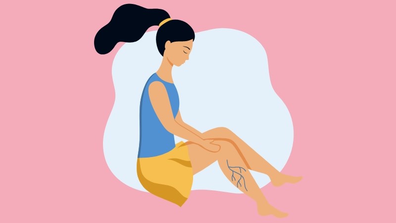 Người suy giãn tĩnh mạch chân có nguy cơ cao bị thuyên tắc phổi Người suy giãn tĩnh mạch chân có nguy cơ cao bị thuyên tắc phổi