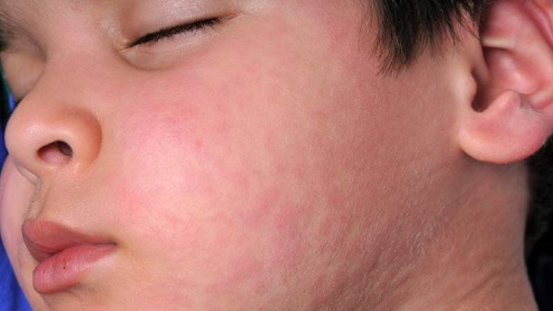 Nổi mề đay và sưng mặt, cổ là phản ứng nguy hiểm nhưng ít gặp khi tiêm vắc-xin