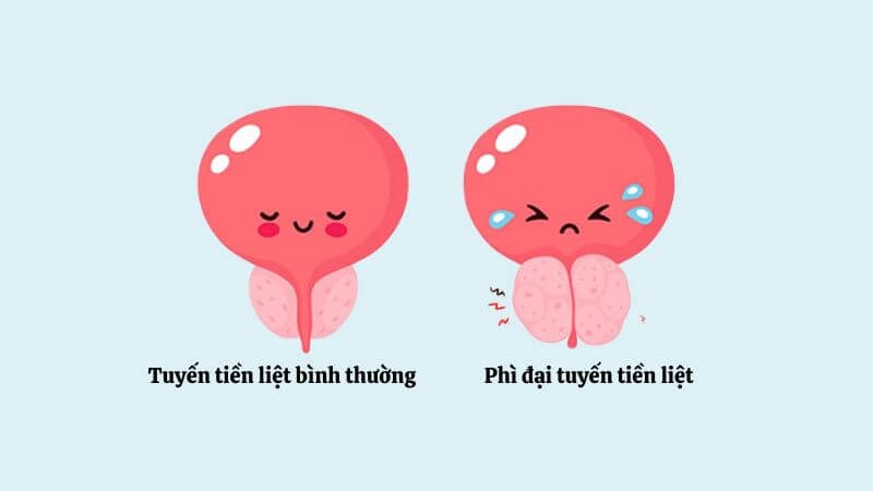 Phì đại tuyến tiền liệt có thể dẫn đến tiểu đêm nhiều lần