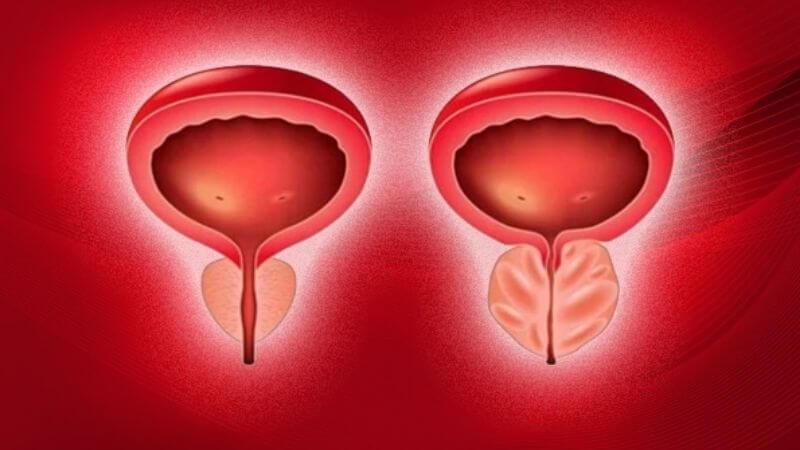 Phì đại tuyến tiền liệt là nguyên nhân gây ra tiếu rắt