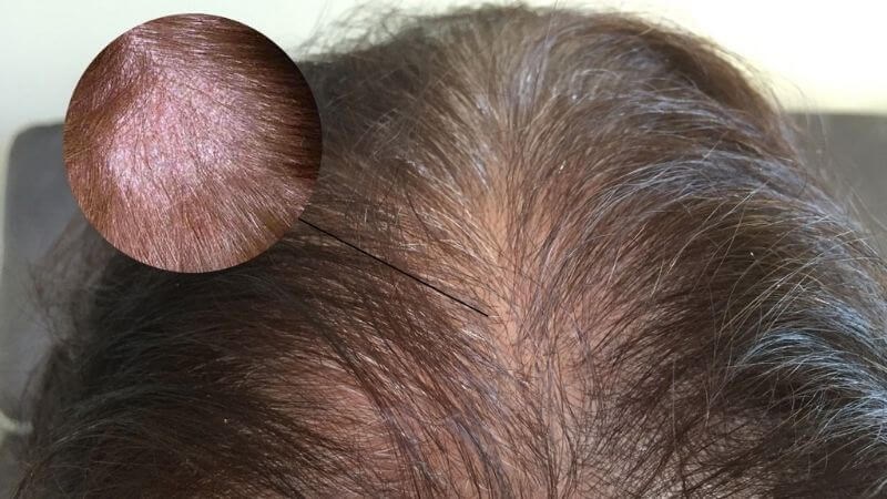 Rụng tóc nhiều ở nam tuổi dậy thì - Trẻ có thể bị hói đầu sớm?