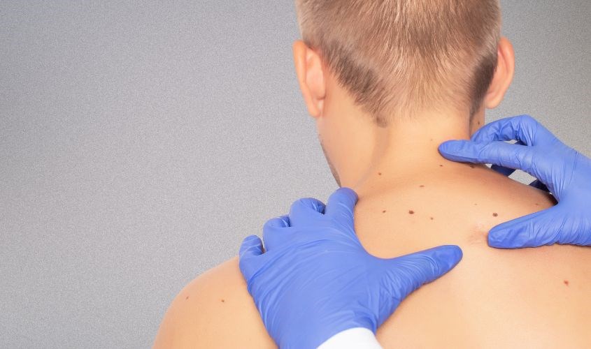 Sử dụng kem chống nắng sẽ giúp nam giới ngăn ngừa nguy cơ ung thư da Sử dụng kem chống nắng sẽ giúp nam giới ngăn ngừa nguy cơ ung thư da