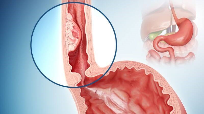 Ung thư thực quản là một trong những biến chứng nguy hiểm của bệnh