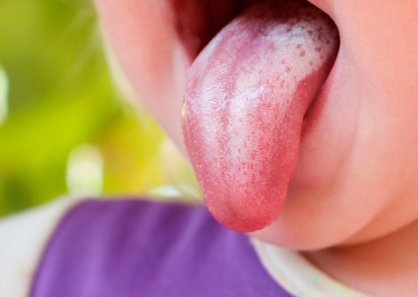 Lưỡi của trẻ xuất hiện đốm trắng là một trong các dấu hiệu để nhận biết trẻ bị nấm lưỡi