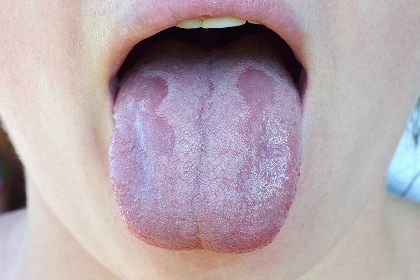 Trẻ bị nấm miệng: Nguyên nhân và cách điều trị bệnh hiệu quả
