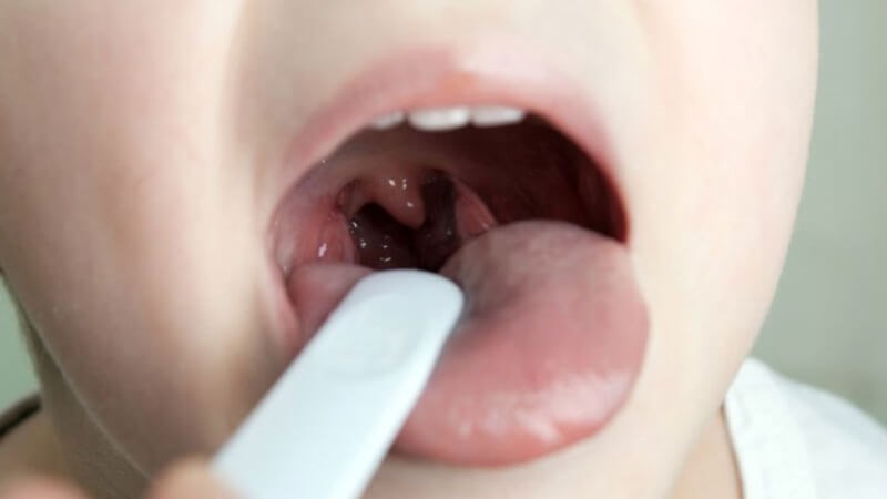 Amidan hoặc v&ograve;m họng sưng to l&agrave;m tăng nguy cơ ngủ ng&aacute;y ở trẻ