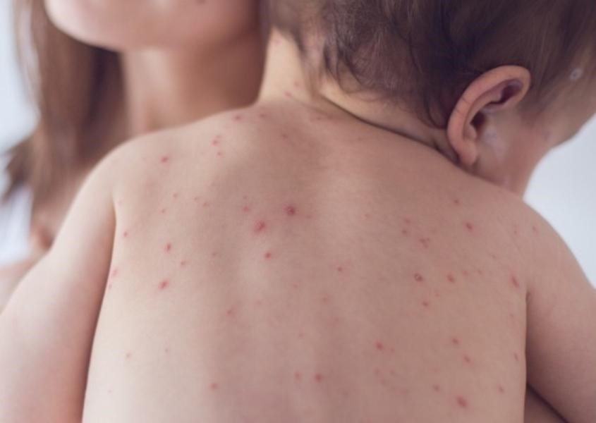 Những điều cha mẹ cần biết về bệnh thủy đậu ở trẻ sơ sinh. Nguồn từ theasiaparent