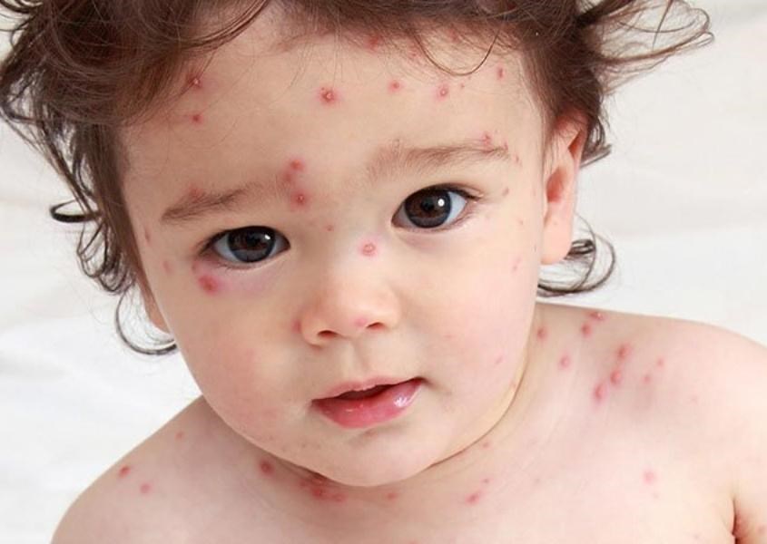 Trẻ bị phát ban đỏ trên đầu và mặt, sau đó lan ra khắp cơ thể. 