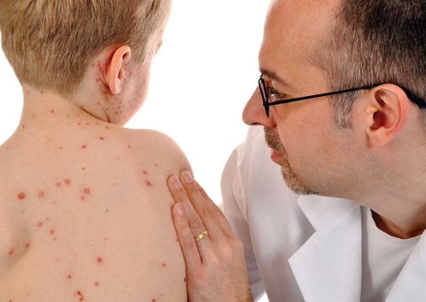 Bác sĩ có thể chẩn đoán bệnh thủy đậu bằng quan sát bằng mắt thường. Nguồn từ blackburnwithdarwenccg