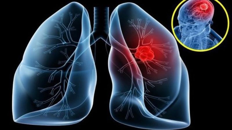Ung thư phổi là tình trạng tăng trưởng không kiểm soát của các tế bào bất thường