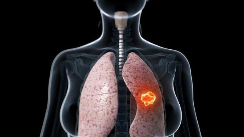Đây là loại ung thư phổi thường gặp, có tốc độ lây lan chậm