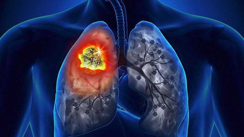 Ung thư phổi tế bào nhỏ phát triển nhanh, có thể lan qua máu và cơ quan khác