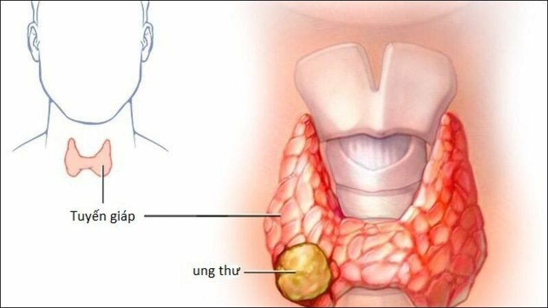 Ung thư tuyến giáp là một loại ung thư nội tiết phổ biến