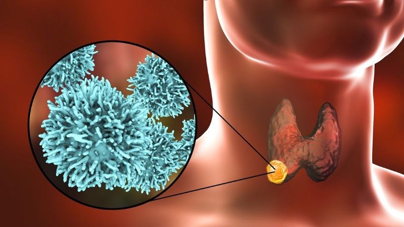 Hầu hết ung thư tuyến giáp giai đoạn sớm không có triệu chứng hoặc dấu hiệu nào