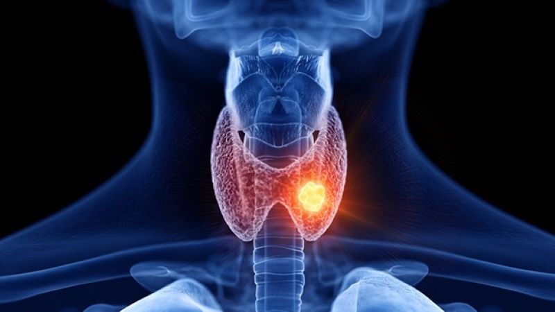 Ung thư tuyến giáp xảy ra khi các tế bào trong tuyến giáp phát triển những đột biến trong DNA 