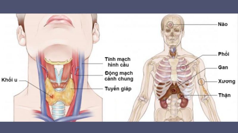 Ung thư tuyến giáp đôi khi lây lan đến các hạch bạch huyết gần đó hoặc các bộ phận khác của cơ thể