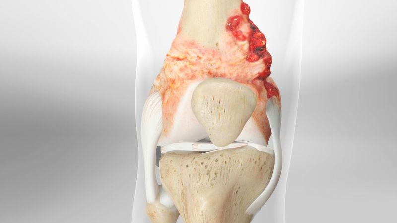Sarcoma xương là một loại ung thư xương xuất hiện trong các tế bào hình thành xương