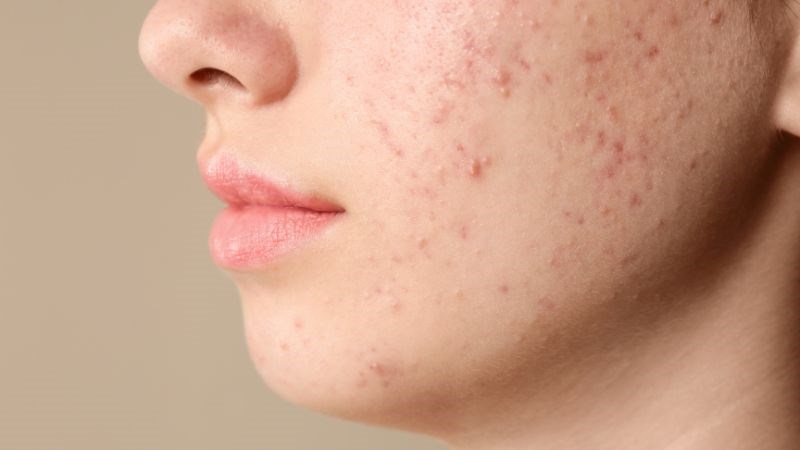 Mụn nội tiết xuất hiện do có sự tăng tiết dầu và bít tắc lỗ chân lông