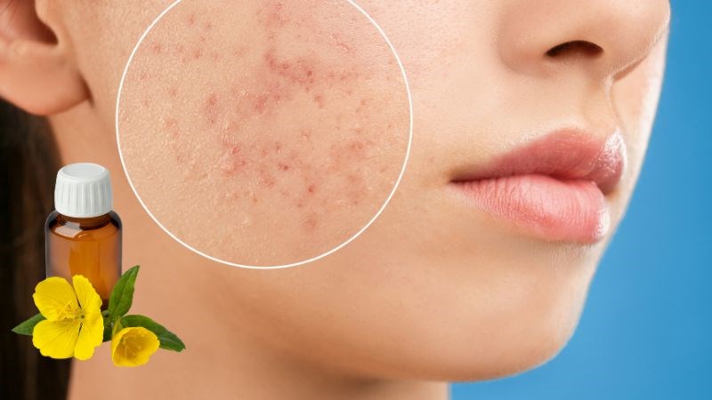 Tinh dầu hoa anh thảo có tác dụng với hầu hết các loại mụn