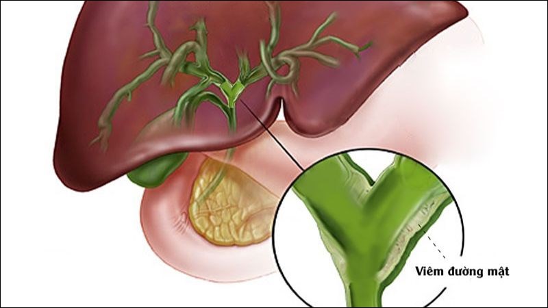 Viêm đường mật cấp nặng là một biến chứng phổ biến nhất của tình trạng vàng da tắc mật