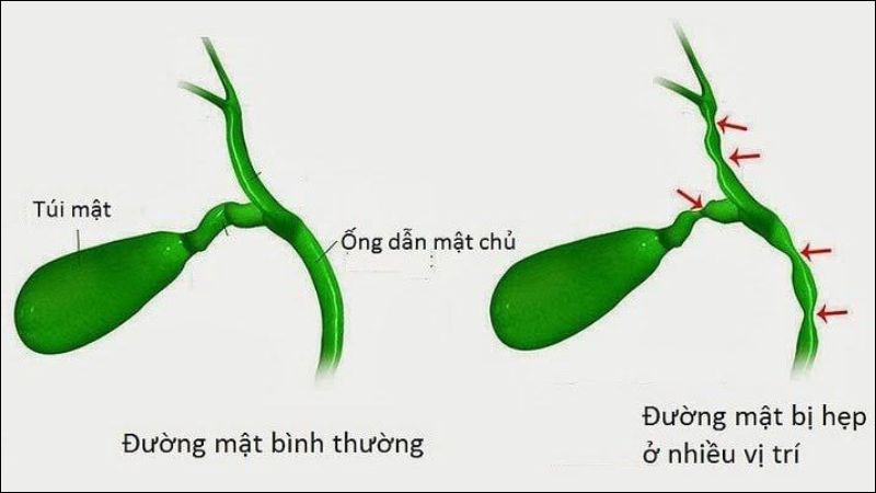 Tình trạng dị dạng đường mật bẩm sinh là khi ống dẫn mật chủ không phát triển bình thường khiến đường mật bị hẹp lại