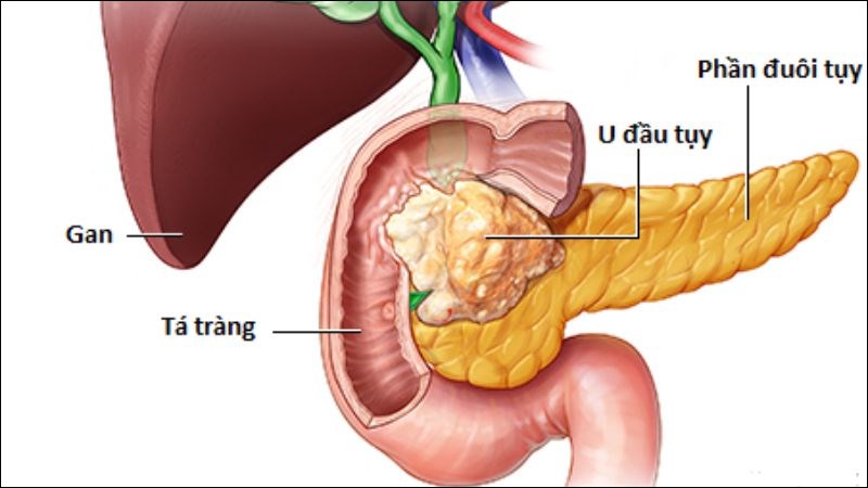 Ung thư đầu tụy chiếm 60% số ca u tụy, có thể gây biến chứng tắc mật