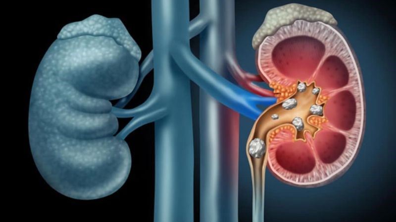 Sỏi thận có thể dẫn đến sỏi niệu quản