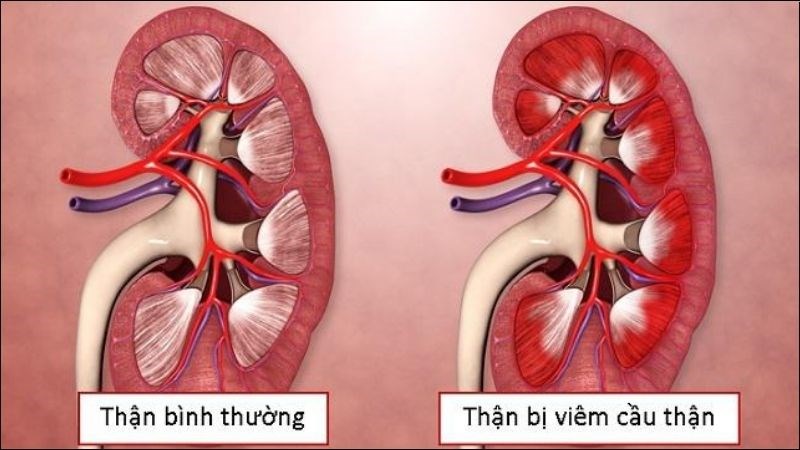 6. Phòng ngừa viêm cầu thận cấp