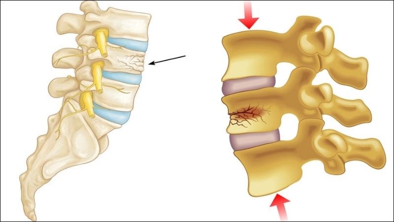Viêm cột sống dính khớp gây xẹp đốt sống và gãy xương
