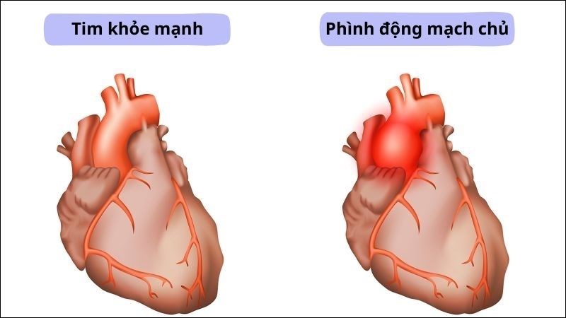 Viêm cột sống dính khớp có thể dẫn tới tình trạng viêm và phình động mạch chủ