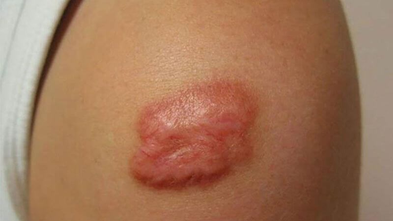 Viêm da mủ hoại thư nếu không điều trị đúng cách có thể dẫn đến sẹo khó điều trị Viêm da mủ hoại thư nếu không điều trị đúng cách có thể dẫn đến sẹo khó điều trị