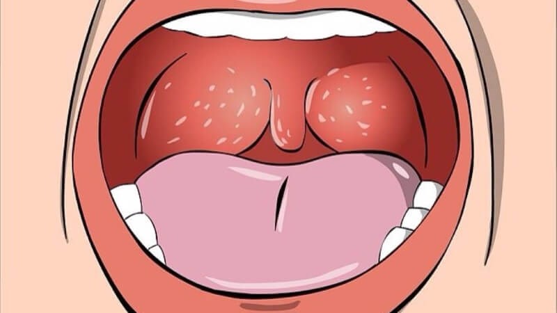 Họng có biểu hiện sưng nóng khi viêm