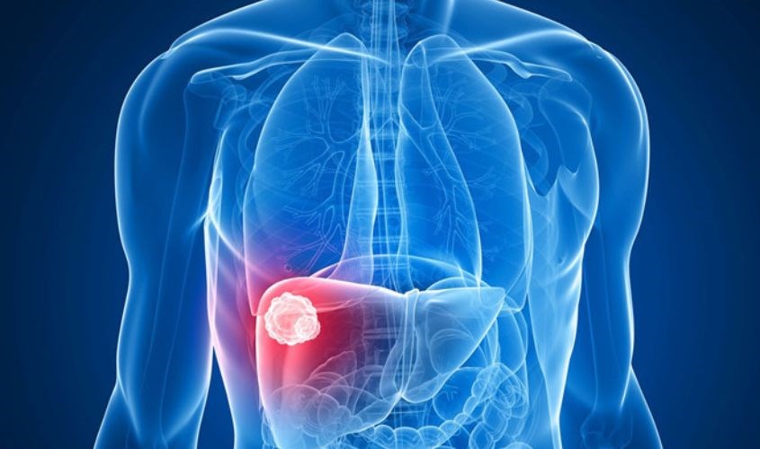 Hệ quả của viêm gan cấp ở bé là bệnh ung thư biểu mô gan 