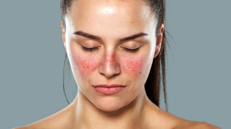 Bệnh lupus ban đỏ hệ thống cũng có thể gây viêm màng bồ đào Bệnh lupus ban đỏ hệ thống cũng có thể gây viêm màng bồ đào
