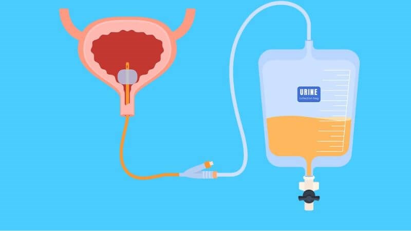 Người có tiền sử đặt ống thông tiểu sẽ dễ bị viêm niệu đạo hơn Người có tiền sử đặt ống thông tiểu sẽ dễ bị viêm niệu đạo hơn