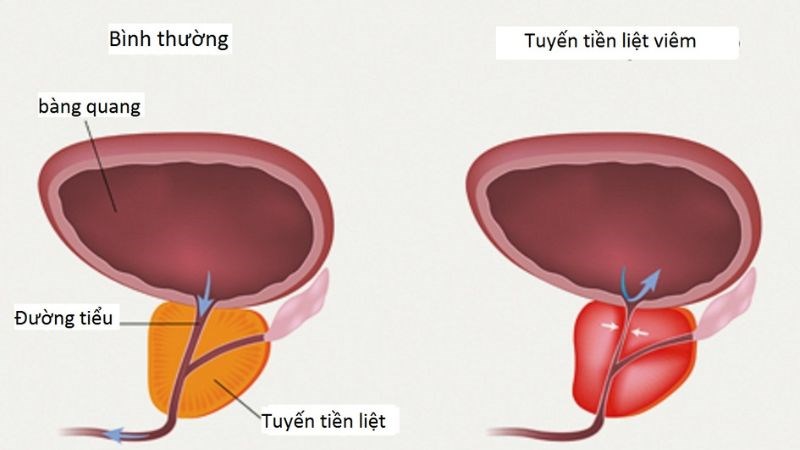Tuyến tiền liệt bị viêm