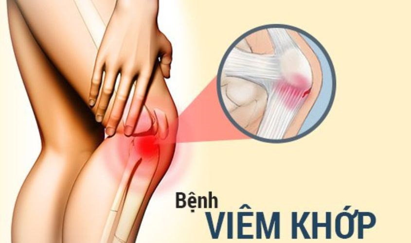 Vitamin b3 giúp giảm tiến triển bệnh viêm khớp