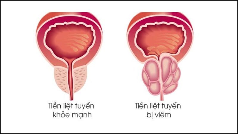 Viêm tuyến tiền liệt có thể là nguyên nhân gây xuất tinh sớm