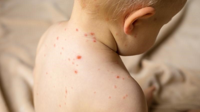 Phát ban là một trong những triệu chứng phổ biến của sốt xuất huyết