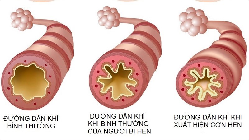 Biến dạng đường thở là một trong các biến chứng nguy hiểm của hen phế quản