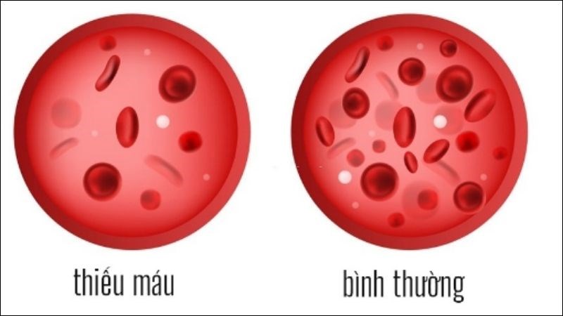 Bệnh Thiếu Máu Là Gì? Tìm Hiểu Nguyên Nhân, Triệu Chứng Và Cách Điều Trị