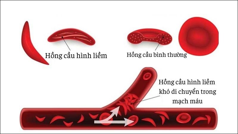 Hồng cầu hình cầu gây giảm khả năng vận chuyển máu đi nuôi cơ thể