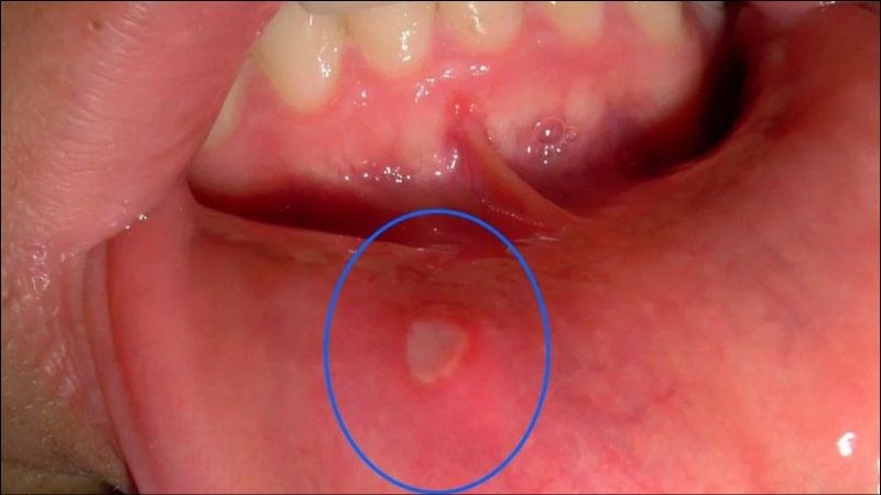  Loét miệng là bệnh gì ? Cách phòng và điều trị loét miệng hiệu quả