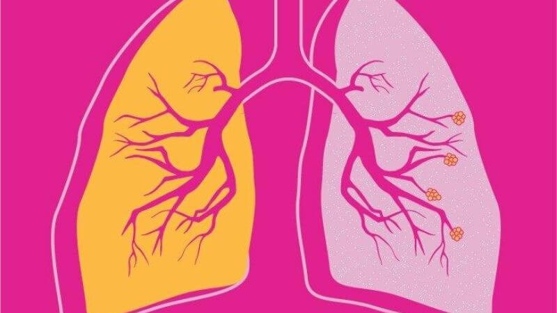Uốn ván có thể gây biến chứng thuyên tắc phổi