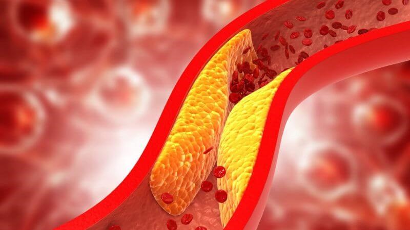 Xơ vữa động mạch là nguyên nhân hàng đầu gây thiếu máu cơ tim