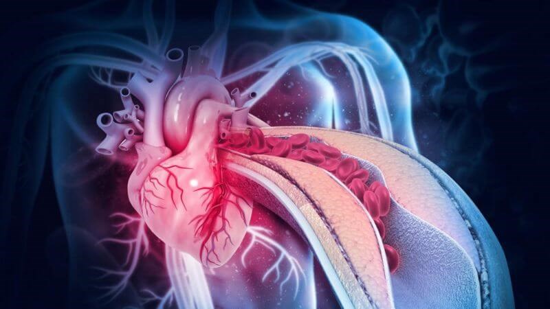 Biến chứng nhồi máu cơ tim có thể đe dọa đến tính mạng của người bệnh