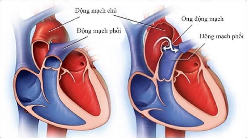 Bệnh tim bẩm sinh: Nguyên nhân, dấu hiệu, cách điều trị và phòng ngừa